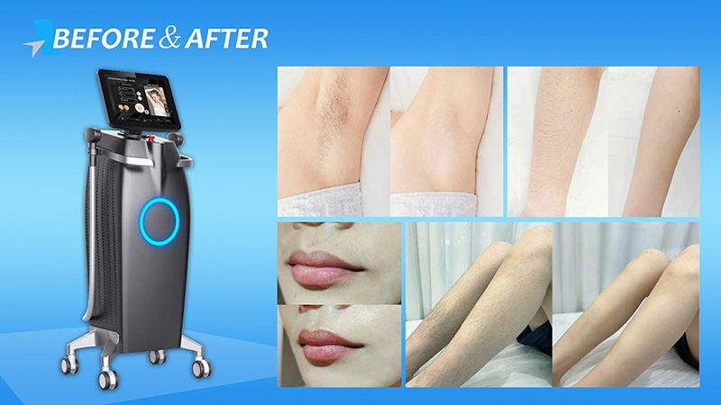 808 Diode Laser Hair Removal Machine: Say Goodbye to Unwanted Hair and Embrace Smooth Skin