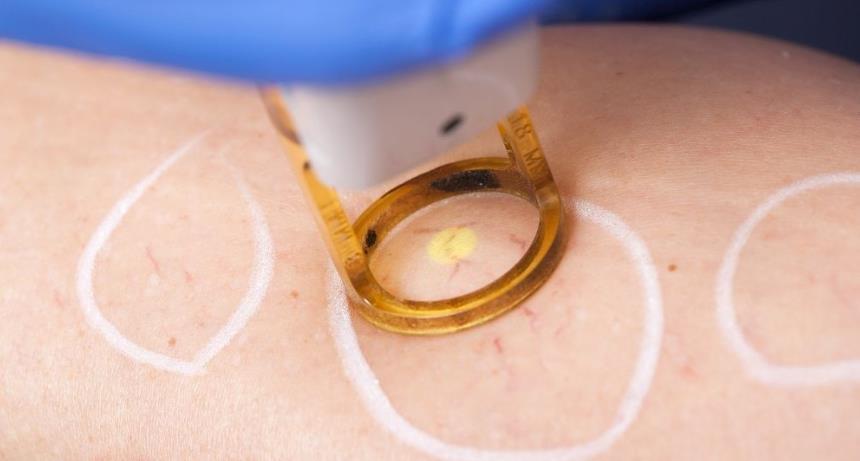 laser treatment for varicose veins